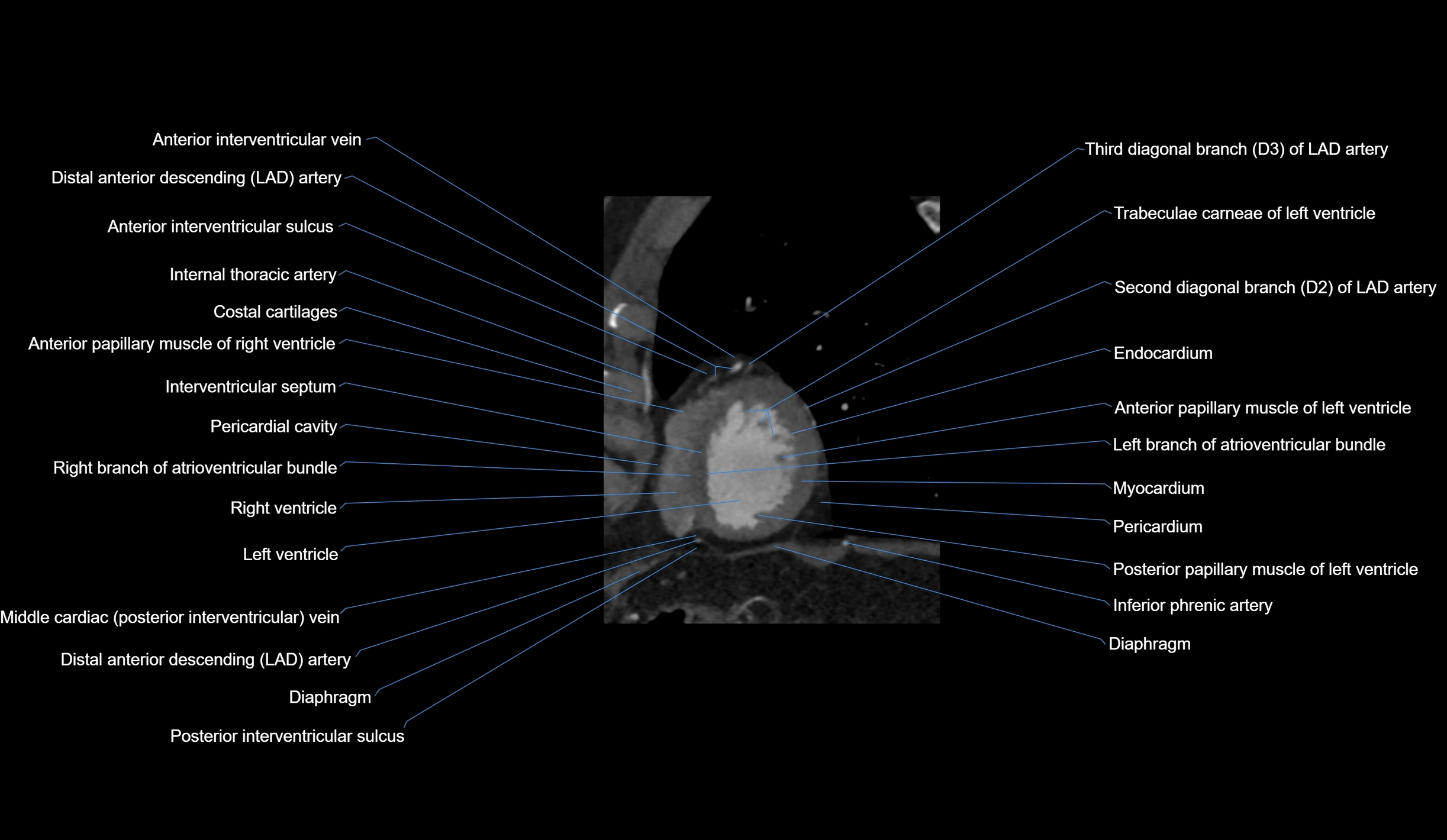 CT heart (coronary angiogram) short axis view  cross sectional anatomy labelled radiology image-00043.webp
